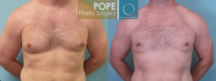 Before & After Male Breast Reduction Case 153 View #1 View in Orlando, FL