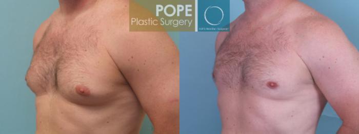 Before & After Male Breast Reduction Case 153 View #2 View in Orlando, FL