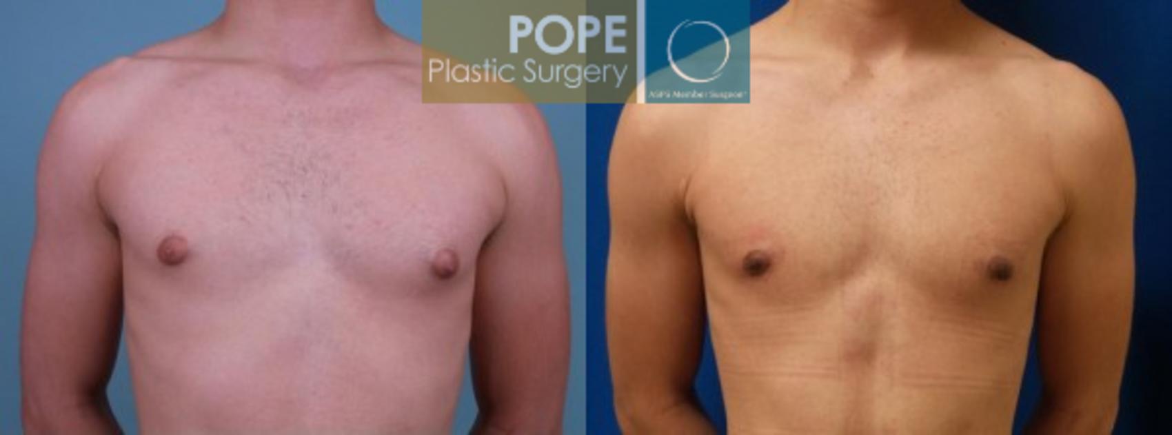 Before & After Male Breast Reduction Case 154 View #1 View in Orlando, FL