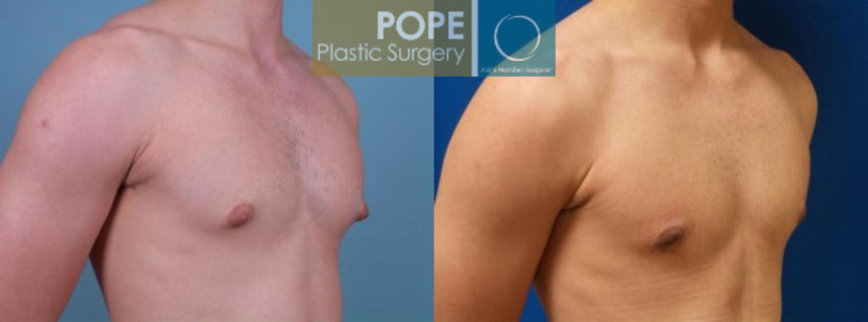 Before & After Male Breast Reduction Case 154 View #2 View in Orlando, FL