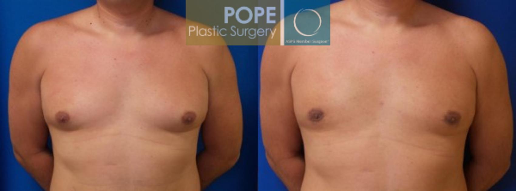 Before & After Male Breast Reduction Case 155 View #1 View in Orlando, FL
