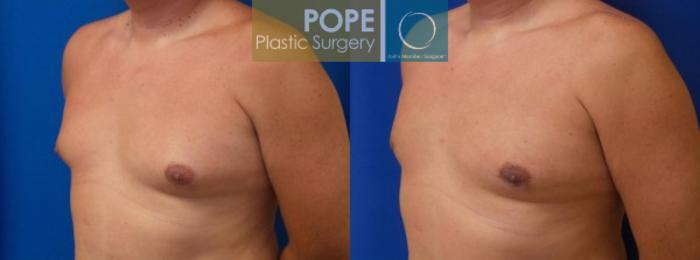 Before & After Male Breast Reduction Case 155 View #2 View in Orlando, FL