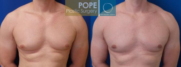 Before & After Male Breast Reduction Case 156 View #1 View in Orlando, FL