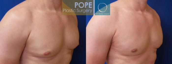 Before & After Male Breast Reduction Case 156 View #2 View in Orlando, FL