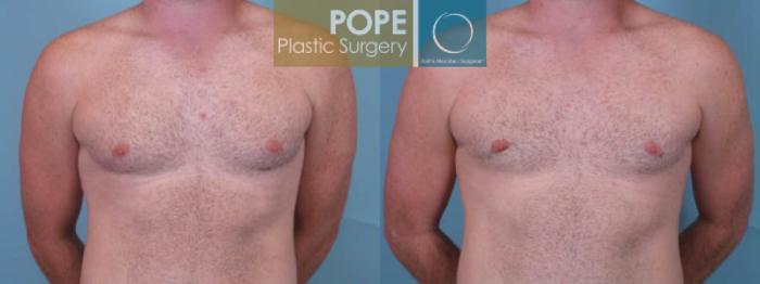 Before & After Male Breast Reduction Case 157 View #1 View in Orlando, FL