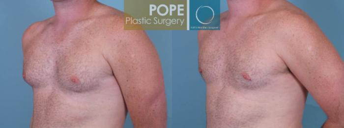 Before & After Male Breast Reduction Case 157 View #2 View in Orlando, FL