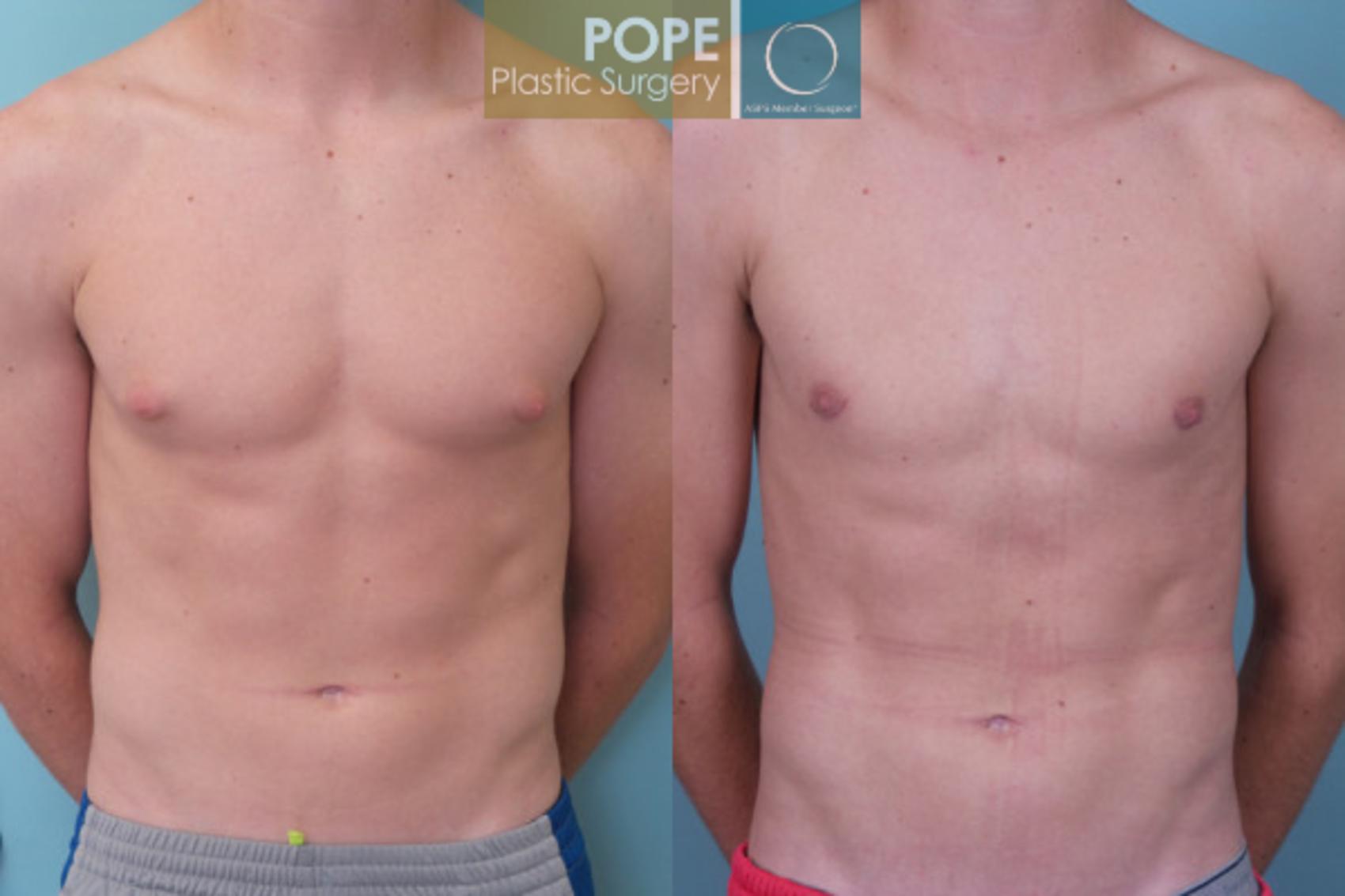 Before & After Male Breast Reduction Case 158 View #1 View in Orlando, FL