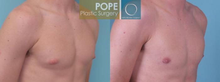Before & After Male Breast Reduction Case 158 View #2 View in Orlando, FL