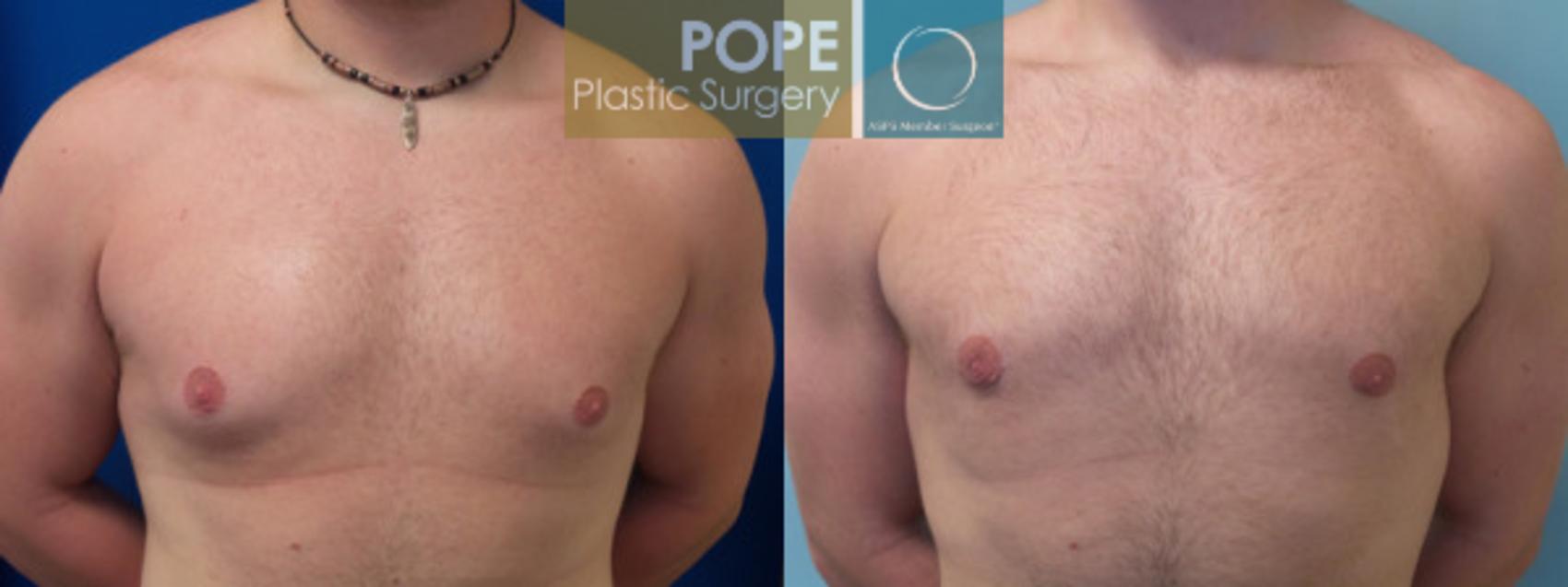 Before & After Male Breast Reduction Case 159 View #1 View in Orlando, FL