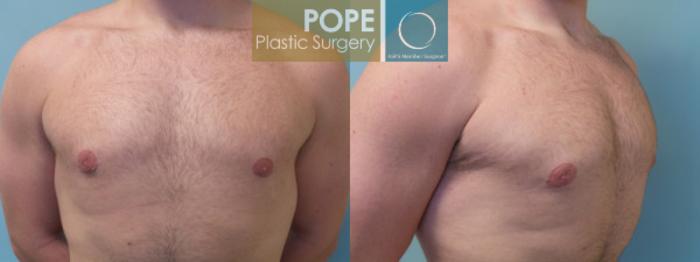 Before & After Male Breast Reduction Case 159 View #2 View in Orlando, FL