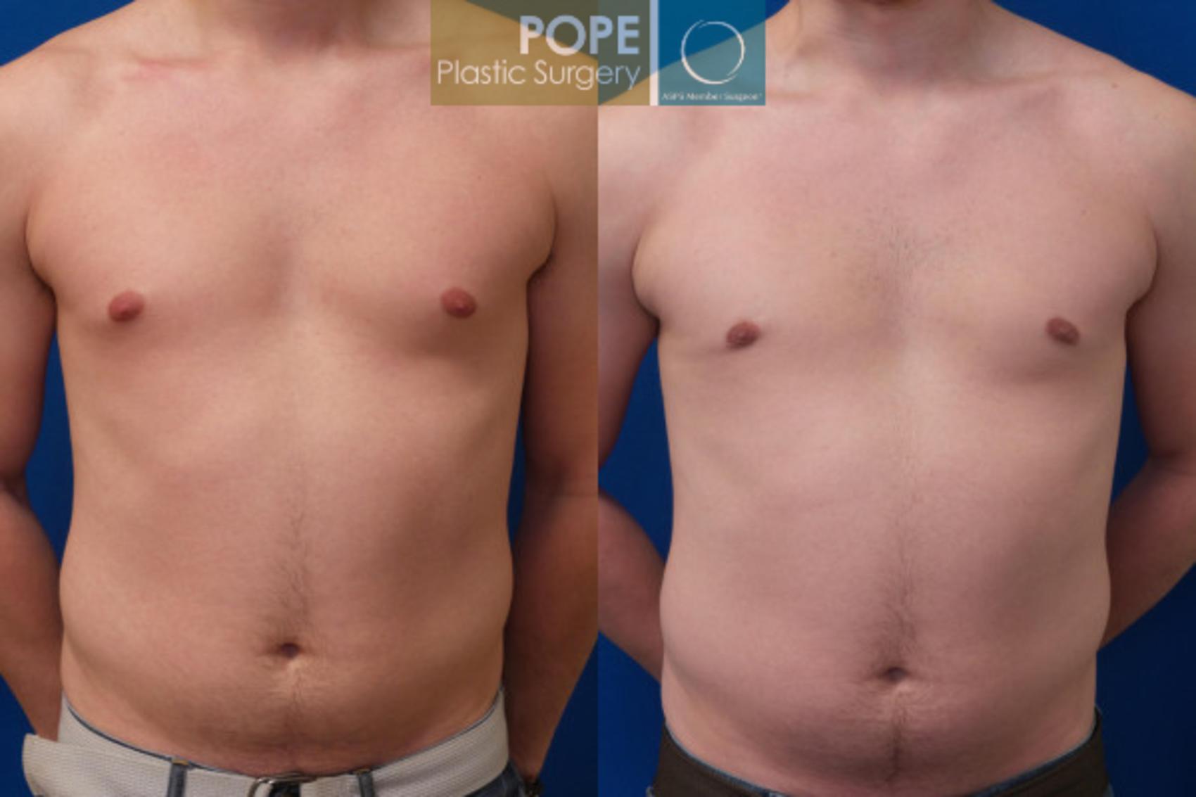 Before & After Male Breast Reduction Case 160 View #1 View in Orlando, FL