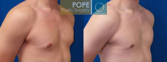 Before & After Male Breast Reduction Case 160 View #2 View in Orlando, FL