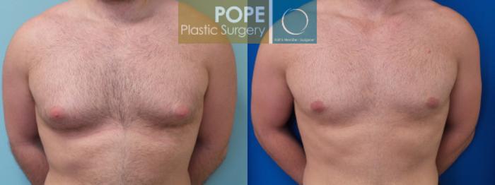 Before & After Male Breast Reduction Case 161 View #1 View in Orlando, FL