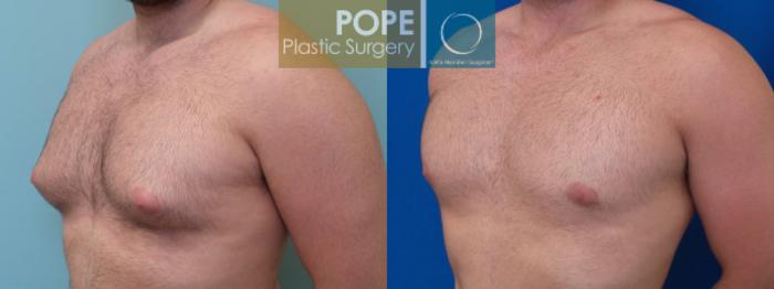 Before & After Male Breast Reduction Case 161 View #2 View in Orlando, FL