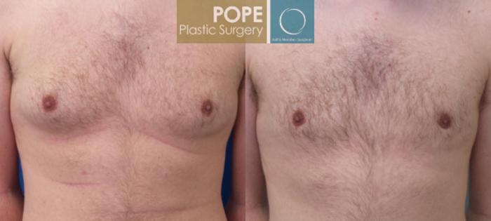 Before & After Male Breast Reduction Case 162 View #1 View in Orlando, FL
