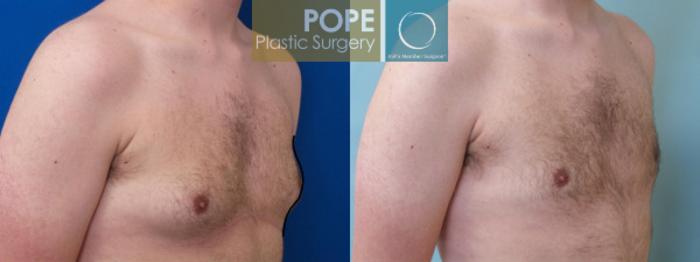 Before & After Male Breast Reduction Case 162 View #2 View in Orlando, FL
