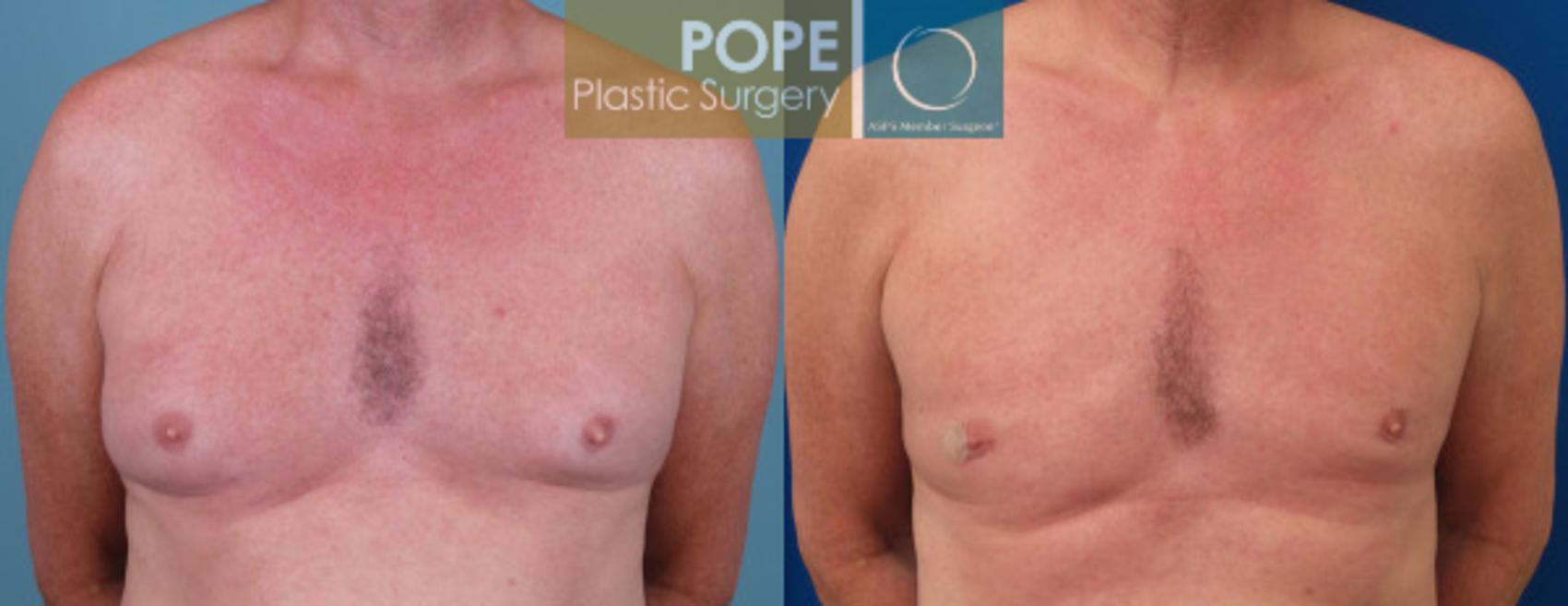 Before & After Male Breast Reduction Case 163 View #1 View in Orlando, FL