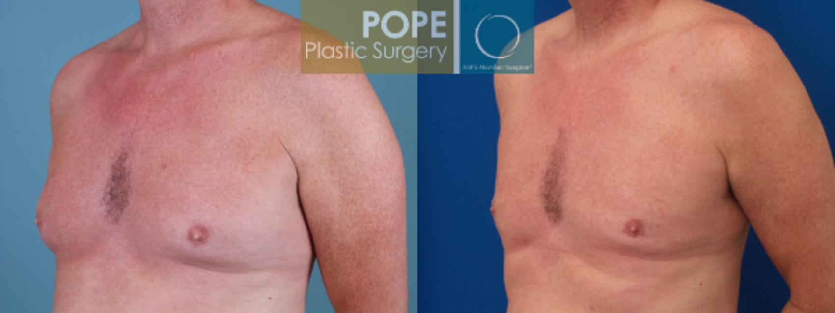 Male Breast Reduction Before & After Photos Patient 163 | Orlando, FL