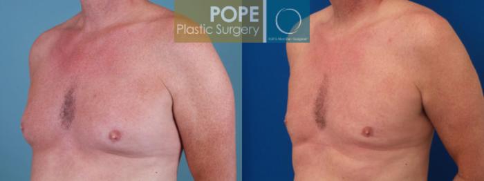 Before & After Male Breast Reduction Case 163 View #2 View in Orlando, FL