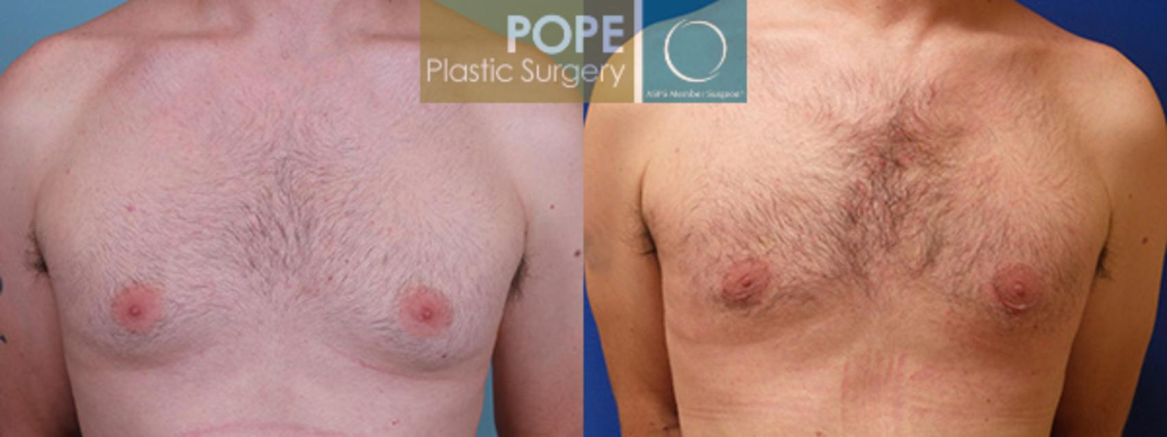 Before & After Male Breast Reduction Case 164 View #1 View in Orlando, FL