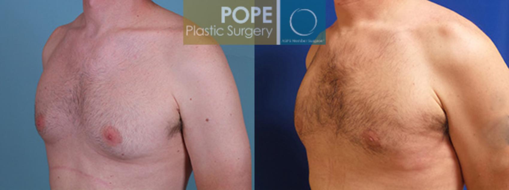 Before & After Male Breast Reduction Case 164 View #2 View in Orlando, FL