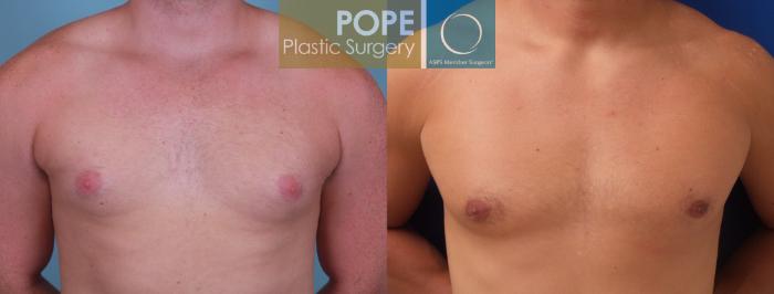 Before & After Male Breast Reduction Case 185 View #1 View in Orlando, FL