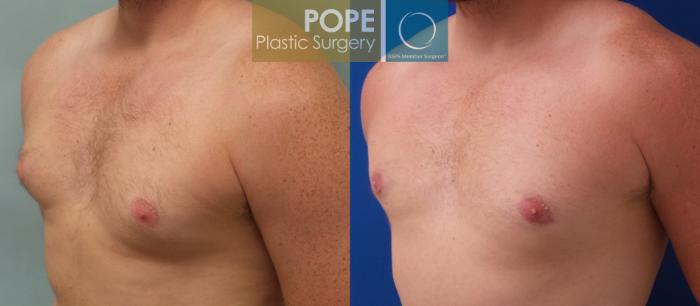 Before & After Male Breast Reduction Case 185 View #2 View in Orlando, FL