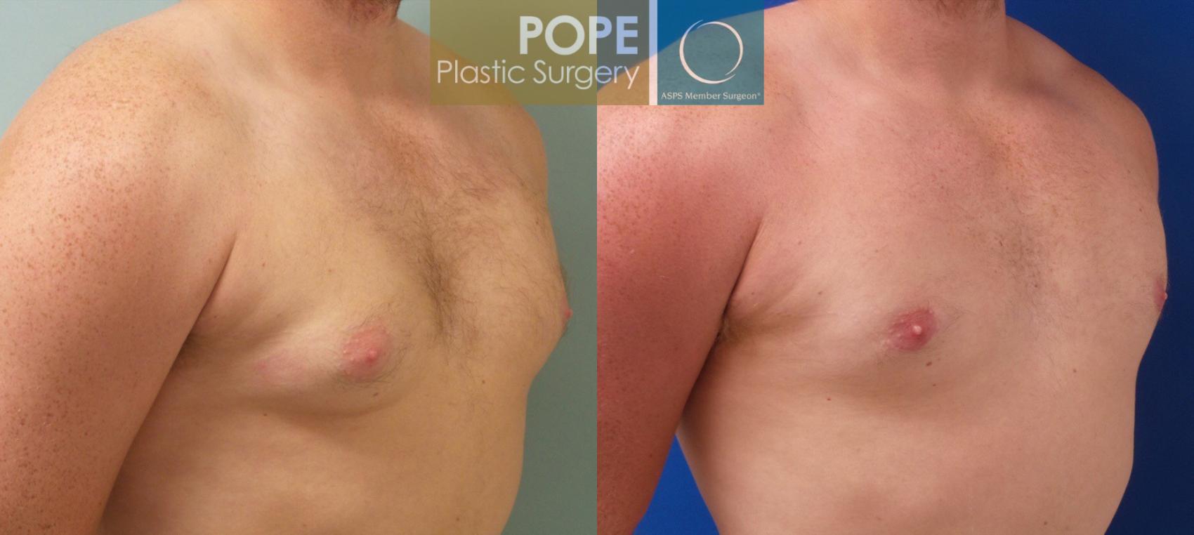 Before & After Male Breast Reduction Case 185 View #3 View in Orlando, FL