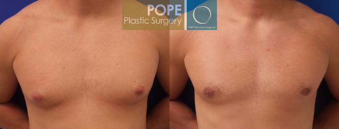 Before & After Male Breast Reduction Case 186 View #1 View in Orlando, FL