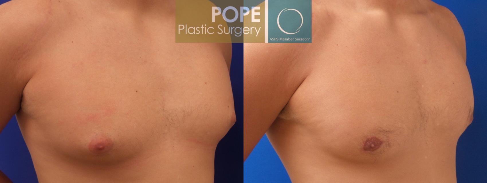 plastic surgery before and after breast