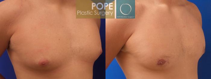 Before & After Male Breast Reduction Case 186 View #2 View in Orlando, FL