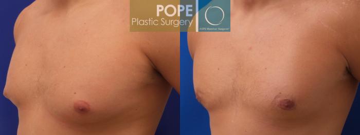 Before & After Male Breast Reduction Case 186 View #3 View in Orlando, FL