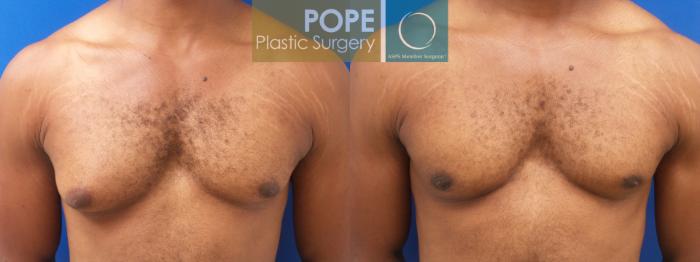 Before & After Male Breast Reduction Case 187 Front View in Orlando, FL