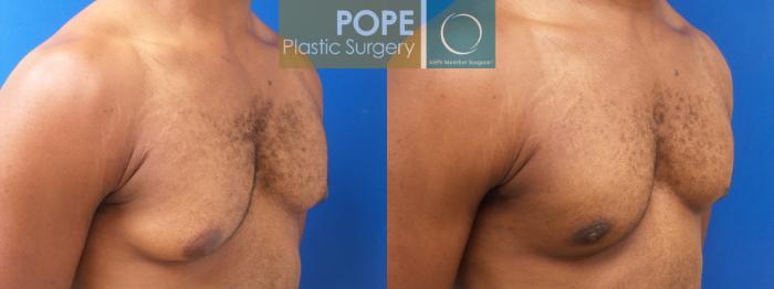 Before & After Male Breast Reduction Case 187 Left Oblique View in Orlando, FL