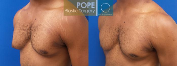 Before & After Male Breast Reduction Case 187 Right Oblique View in Orlando, FL