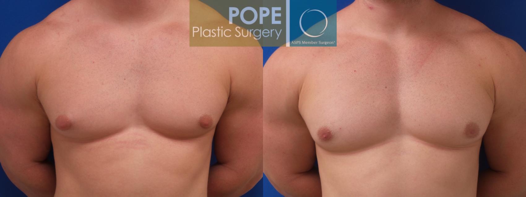 Before & After Male Breast Reduction Case 188 Front View in Orlando, FL