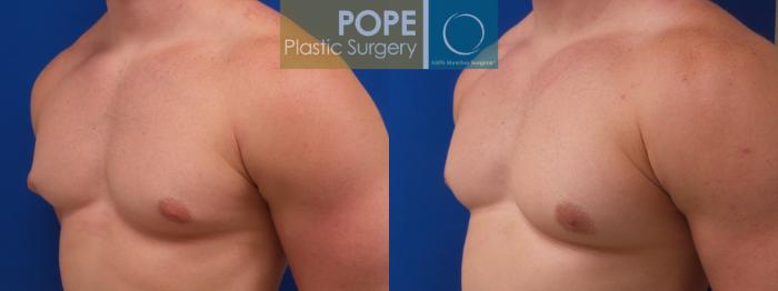 Before & After Male Breast Reduction Case 188 Right Oblique View in Orlando, FL