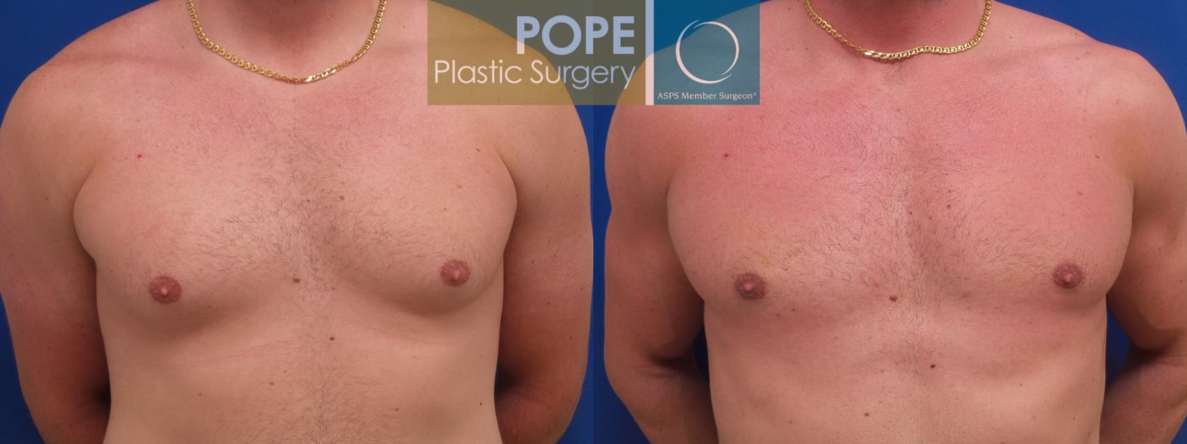 Before & After Male Breast Reduction Case 197 Front View in Orlando, FL