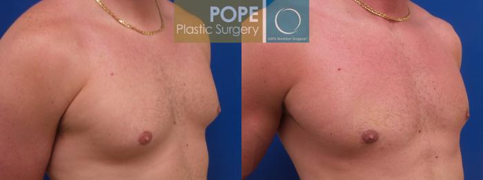 Before & After Male Breast Reduction Case 197 Left Oblique View in Orlando, FL