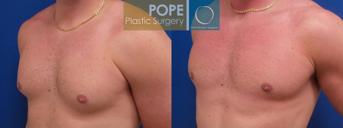 Before & After Male Breast Reduction Case 197 Right Oblique View in Orlando, FL