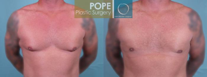 Before & After Male Breast Reduction Case 49 View #1 View in Orlando, FL