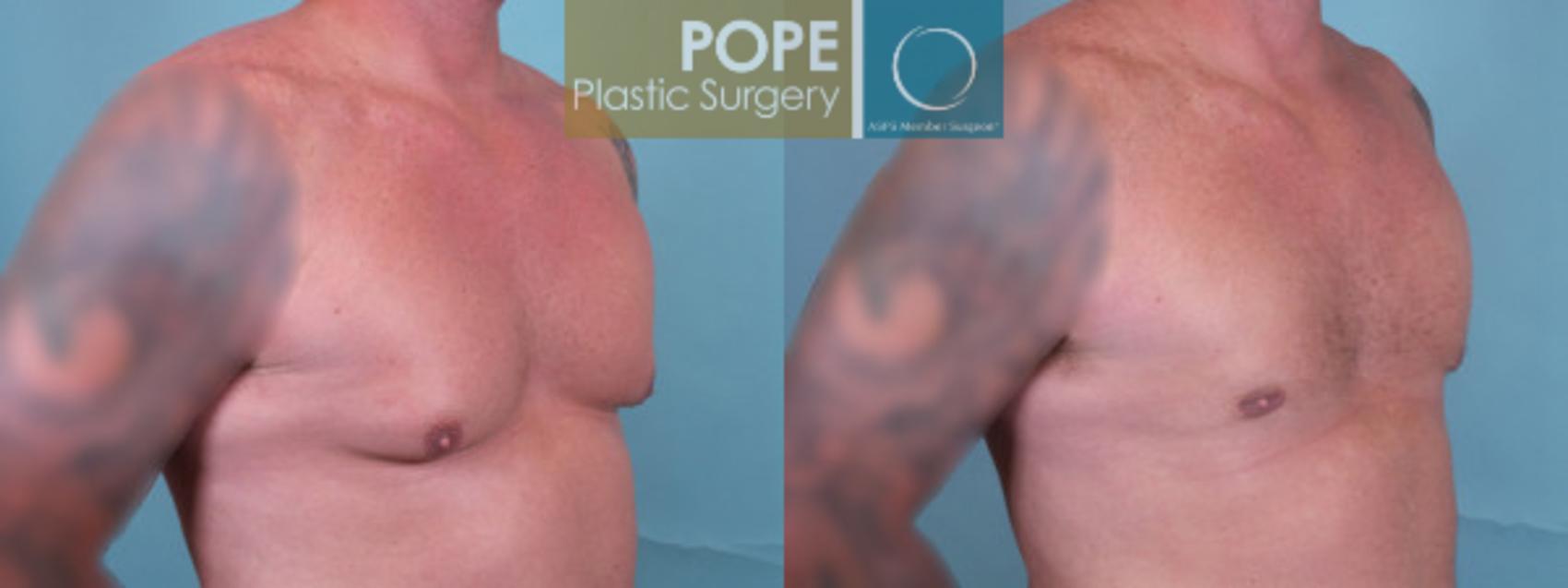 Before & After Male Breast Reduction Case 49 View #2 View in Orlando, FL