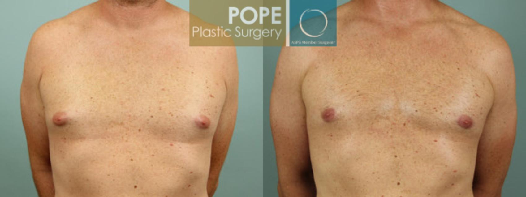 Before & After Body Procedures for Men Case 50 View #1 View in Orlando, FL