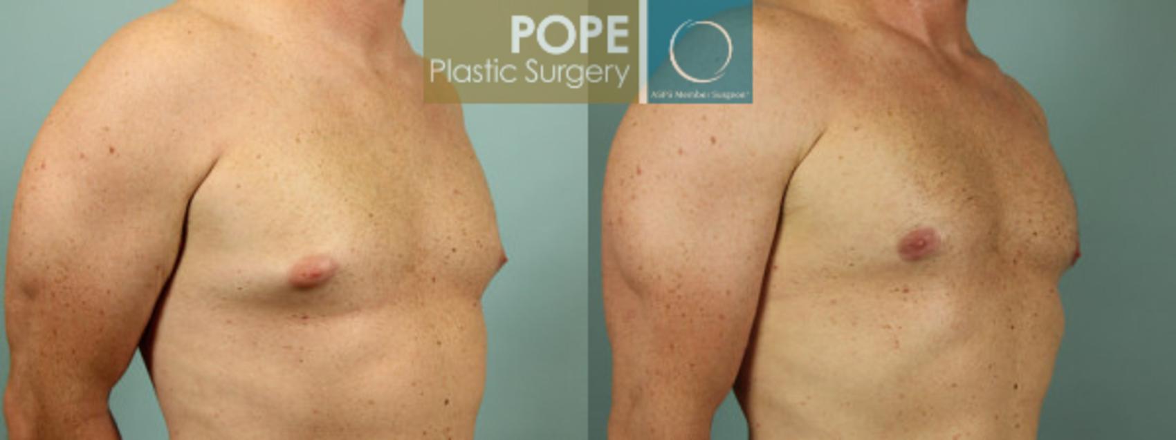 Before & After Male Breast Reduction Case 50 View #2 View in Orlando, FL