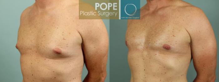 Before & After Male Breast Reduction Case 50 View #3 View in Orlando, FL