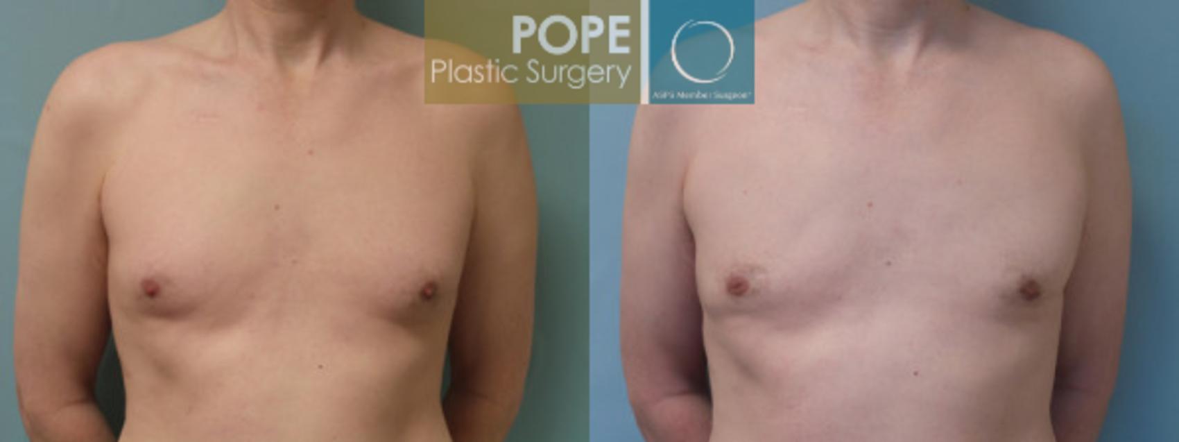 Before & After Male Breast Reduction Case 51 View #1 View in Orlando, FL