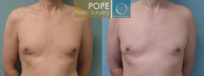 Before & After Male Breast Reduction Case 51 View #1 View in Orlando, FL