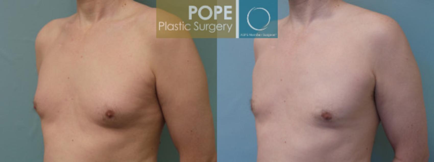 Before & After Male Breast Reduction Case 51 View #2 View in Orlando, FL