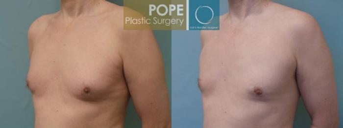 Before & After Body Procedures for Men Case 51 View #2 View in Orlando, FL