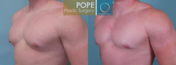 Before & After Male Breast Reduction Case 52 View #2 View in Orlando, FL
